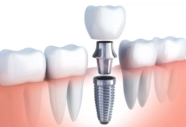 Dental Implants