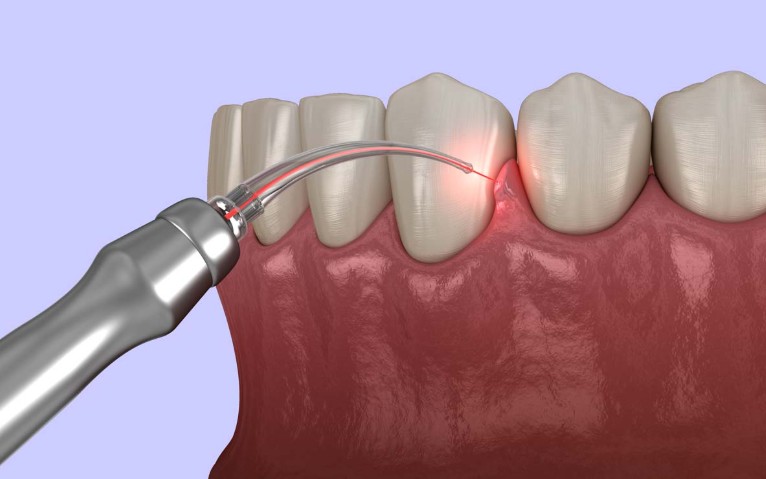 Laser Dentistry