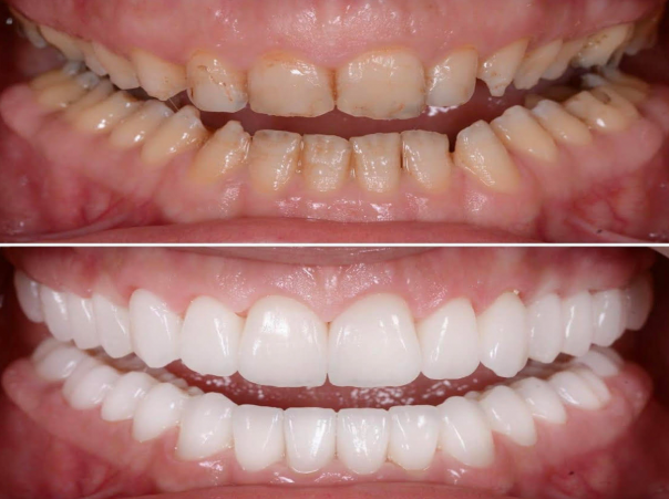 Full Mouth Rehabilitation