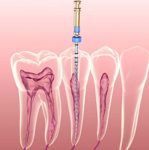 Root Canal Treatment
