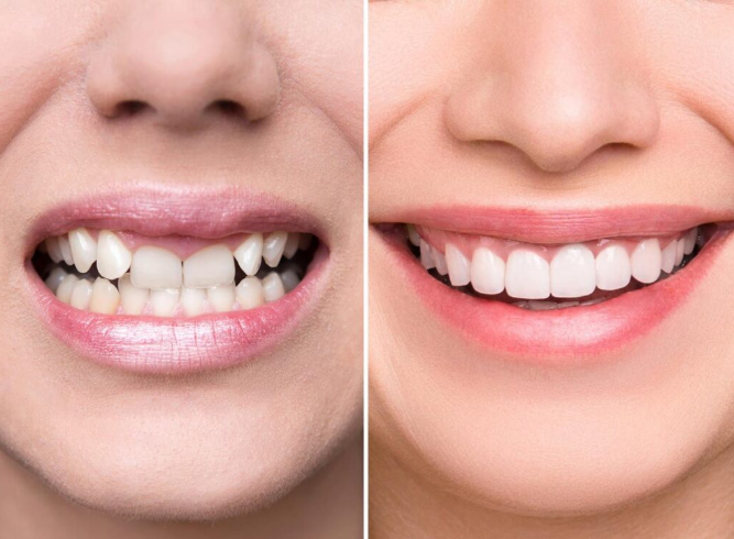 Smile Designing