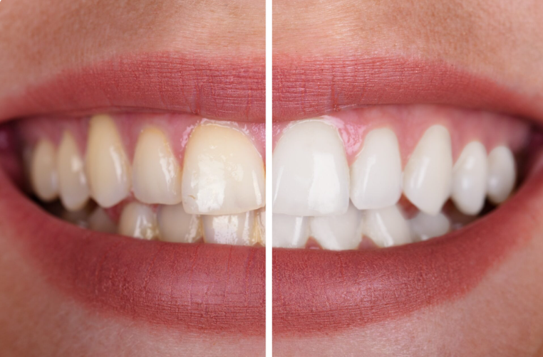 Teeth Whitening