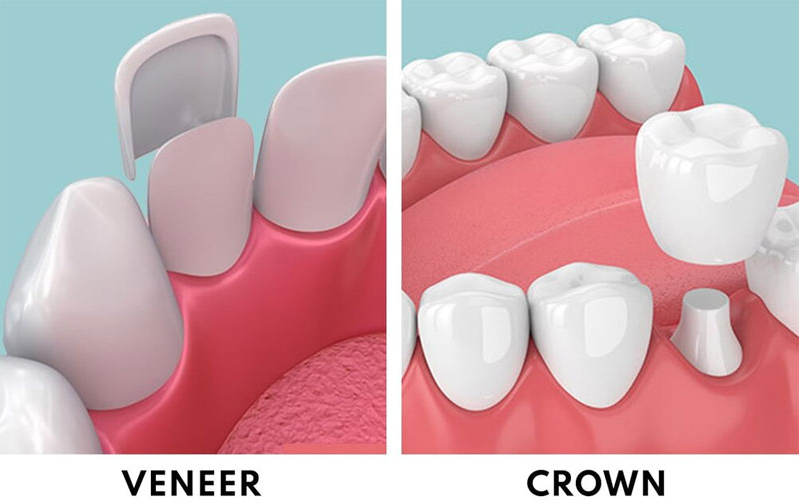Crowns & Veneers